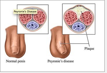 peyronies disease